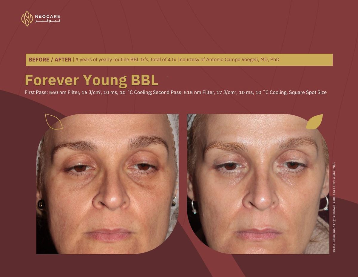 Forever Young BBL before and after 2