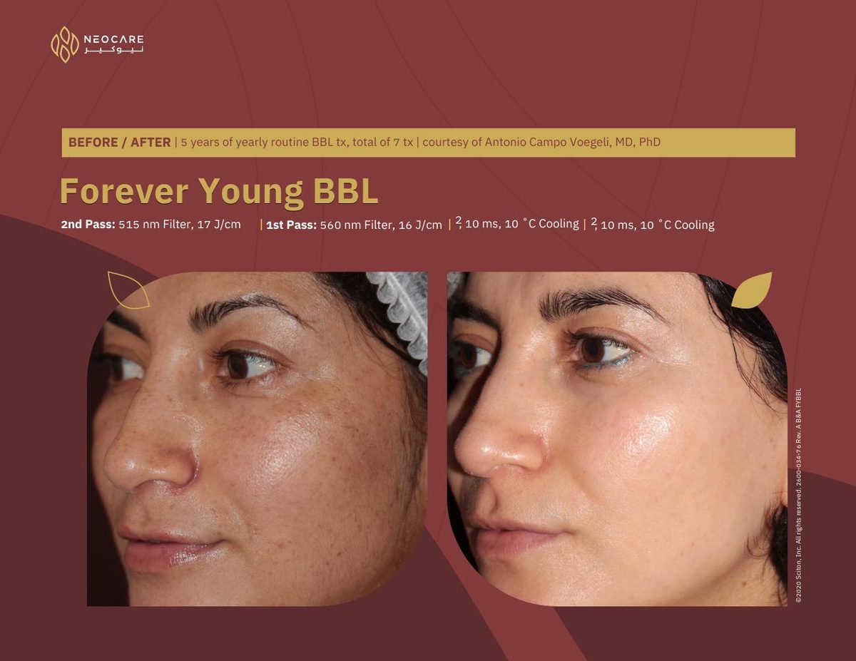 Forever Young BBL before and after 3
