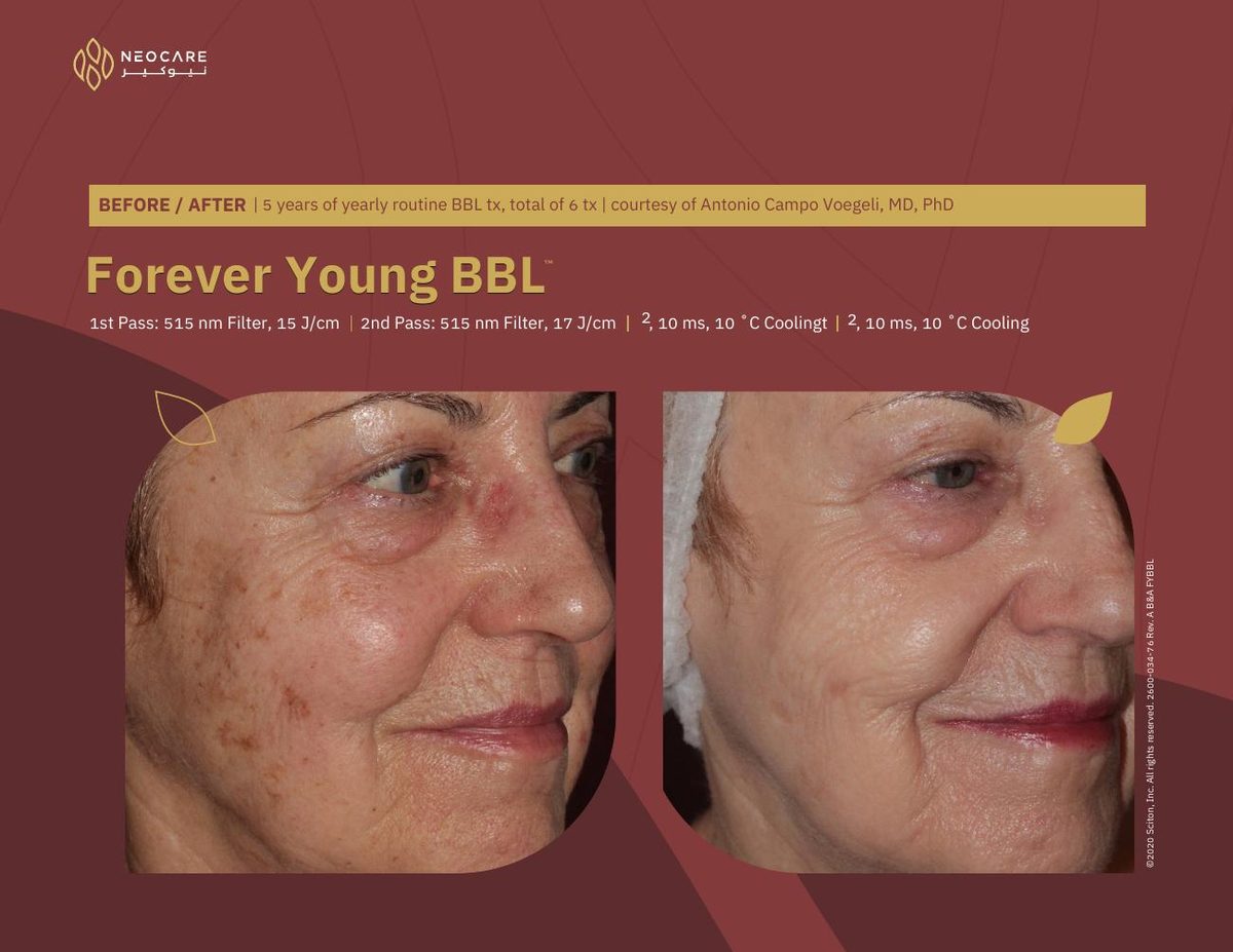 Forever Young BBL before and after 4