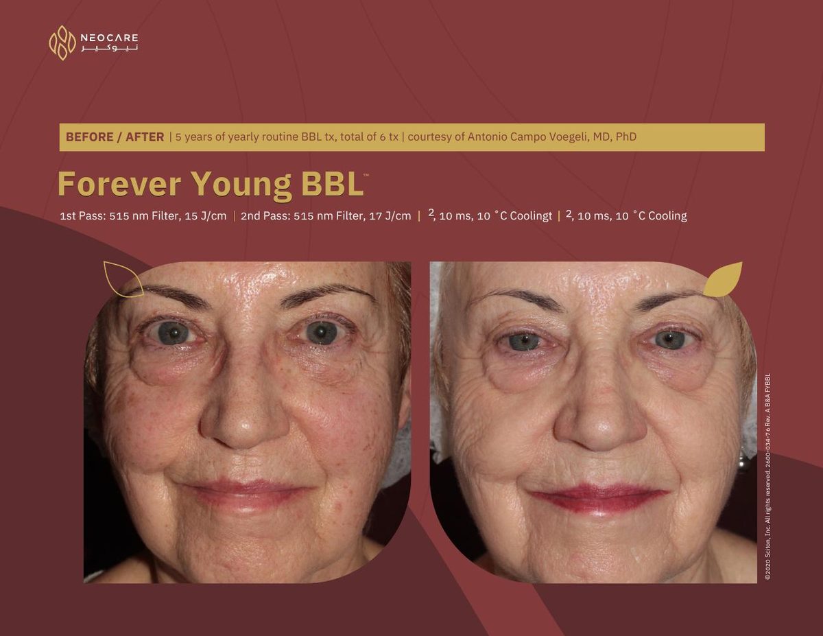 Forever Young BBL before and after 5