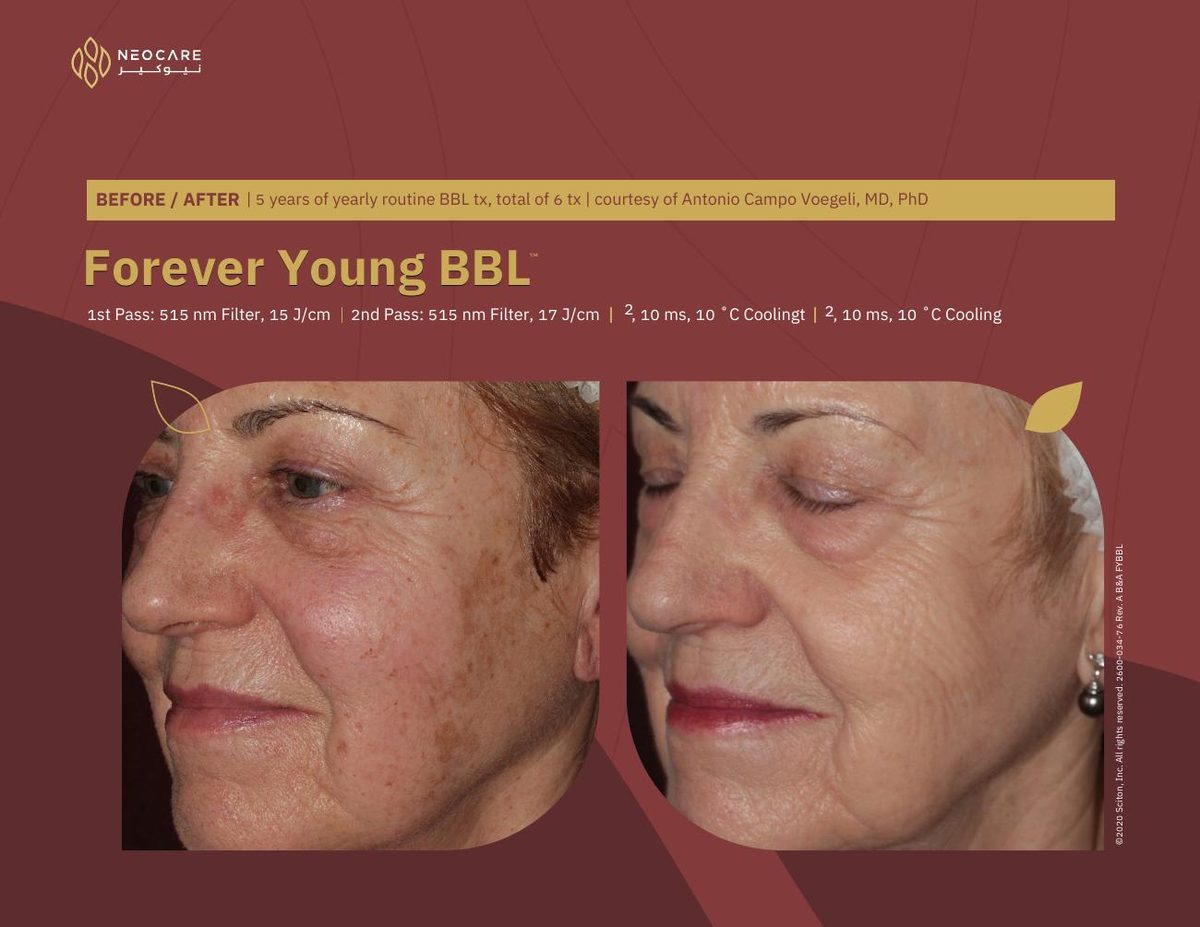 Forever Young BBL before and after 6