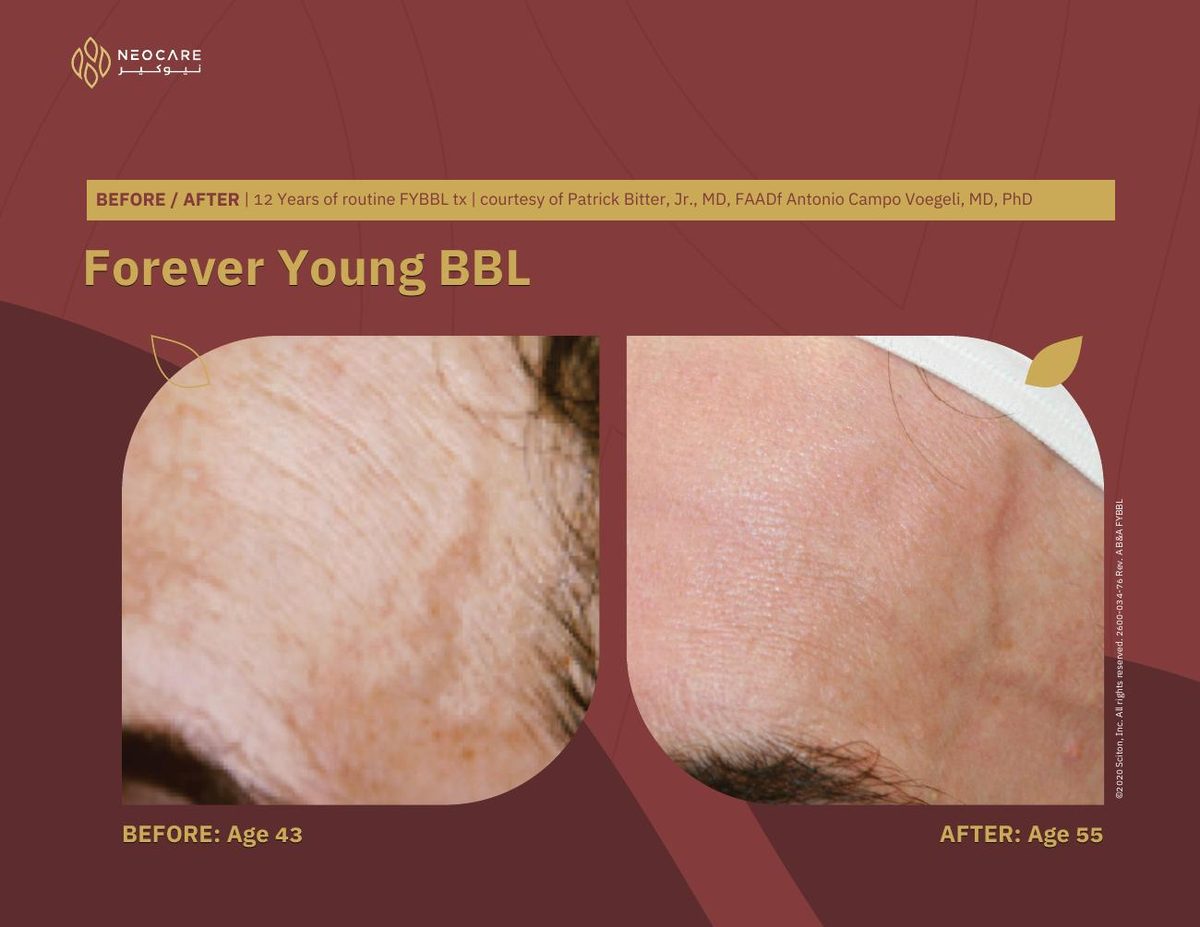 Forever Young BBL before and after 7