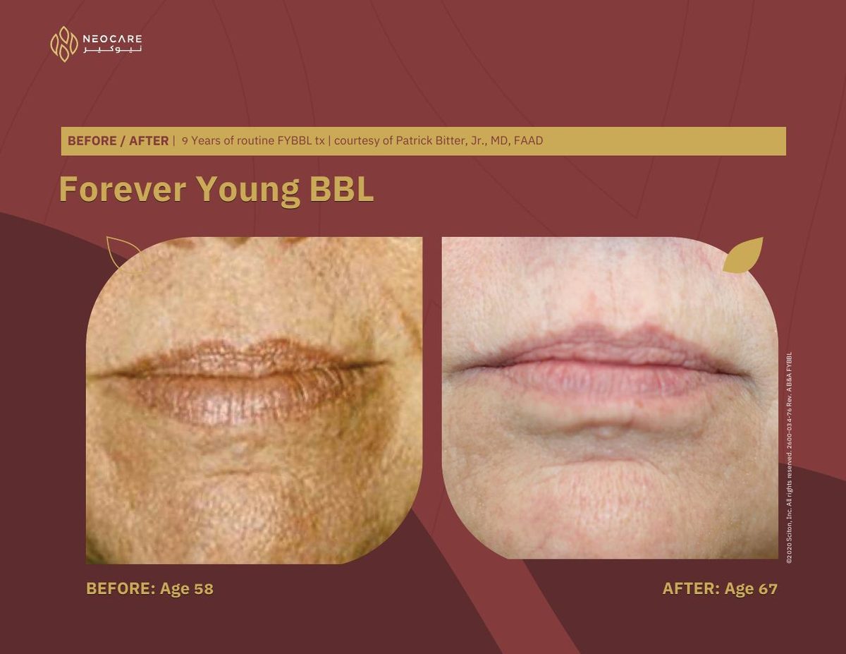 Forever Young BBL before and after 8
