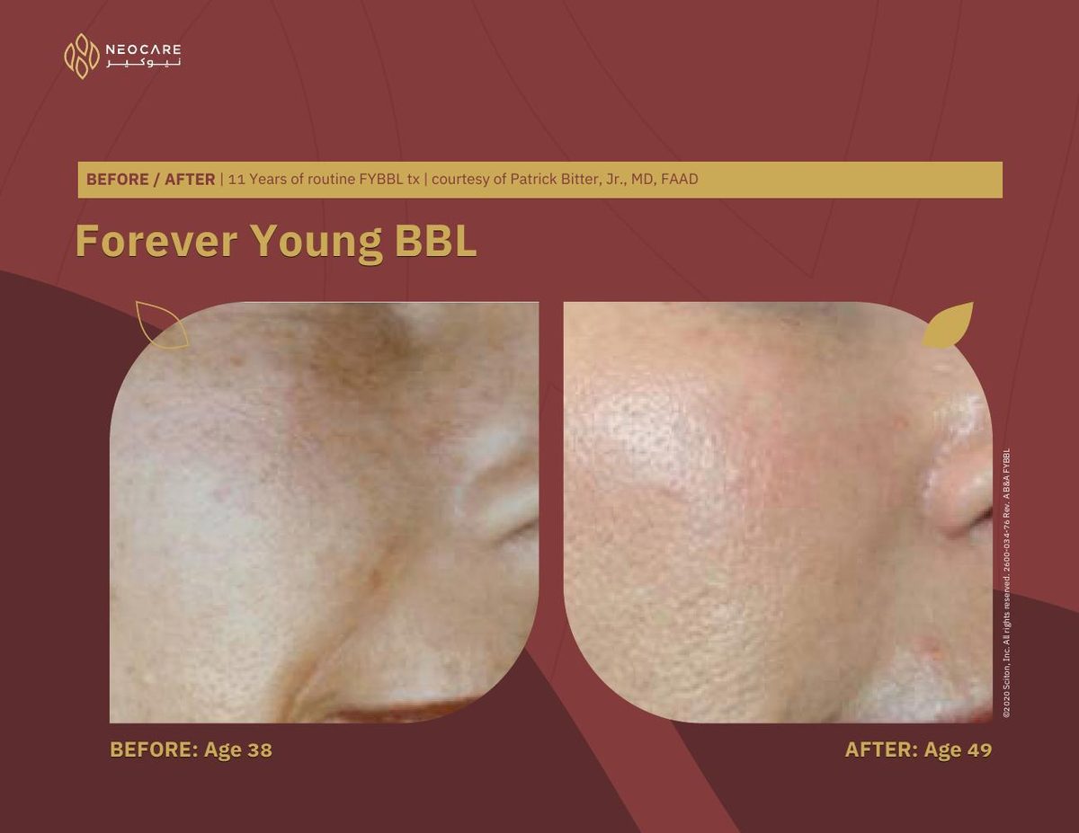 Forever Young BBL before and after 9