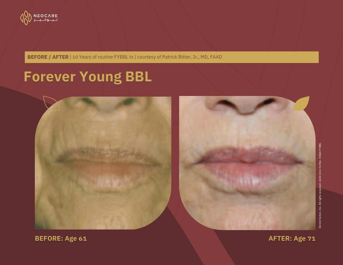 Forever Young BBL before and after 10