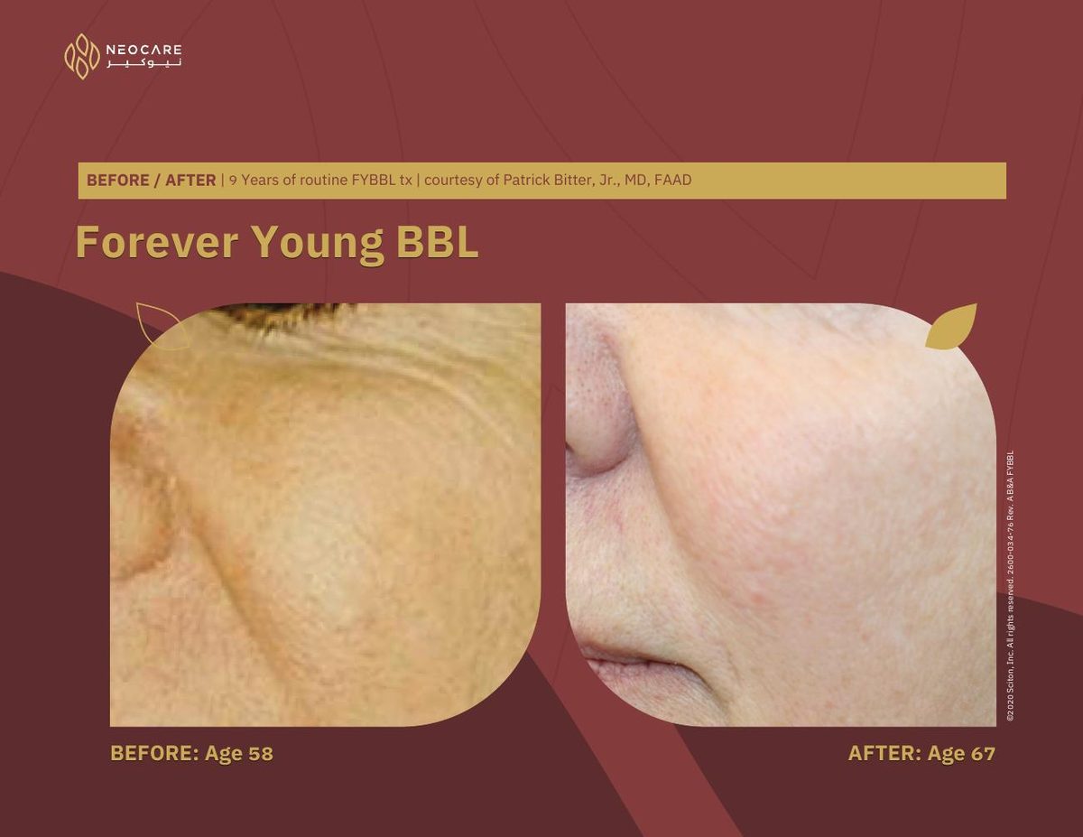 Forever Young BBL before and after 11