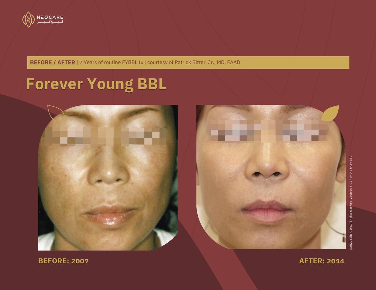 Forever Young BBL before and after 12