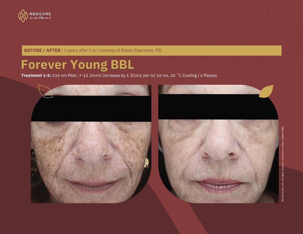 Forever Young BBL before and after 13