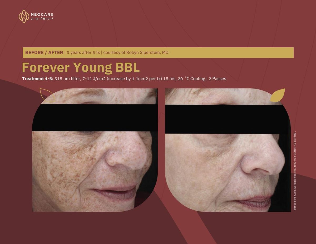 Forever Young BBL before and after 14