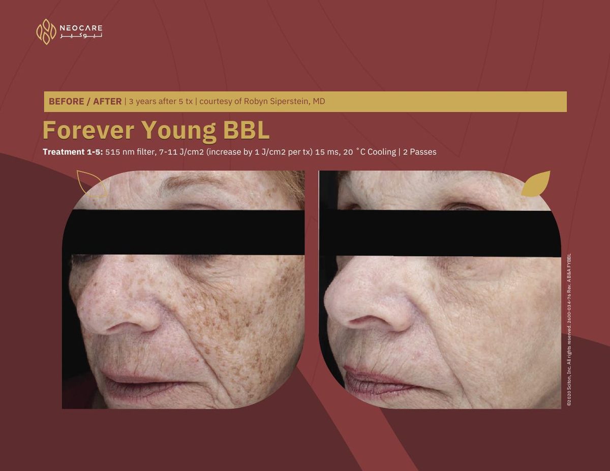 Forever Young BBL before and after 15