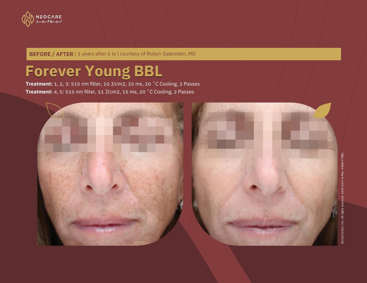 Forever Young BBL before and after 16