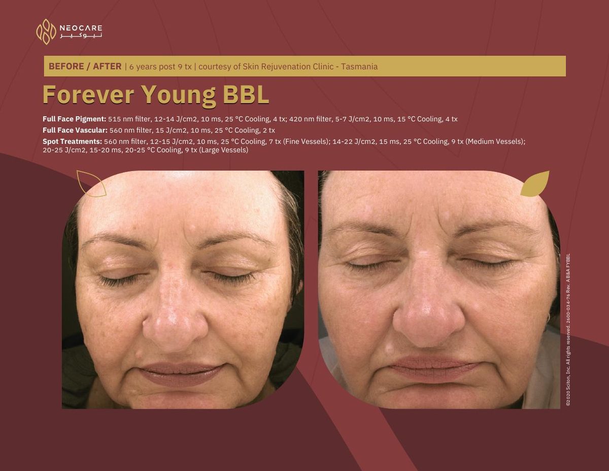 Forever Young BBL before and after 17