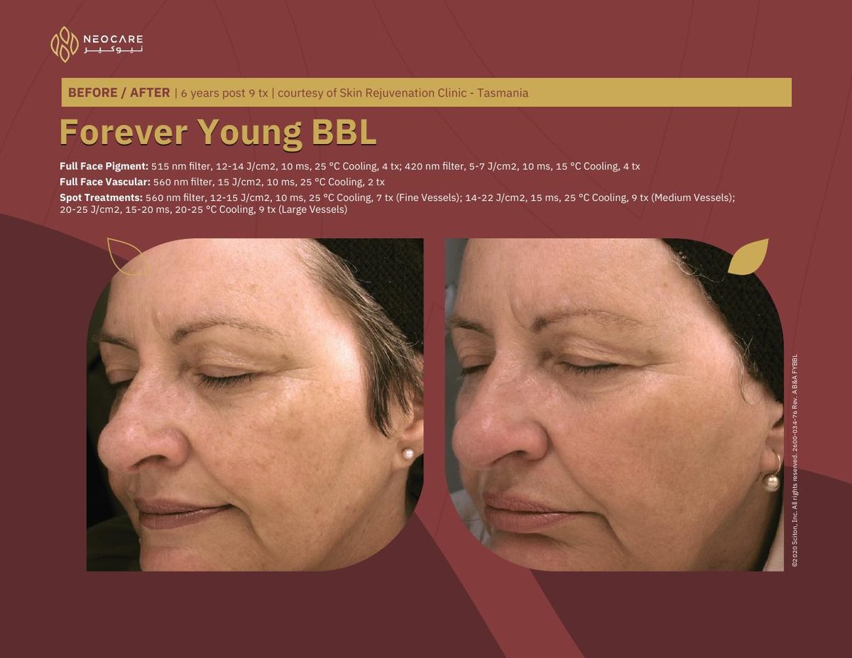 Forever Young BBL before and after 18