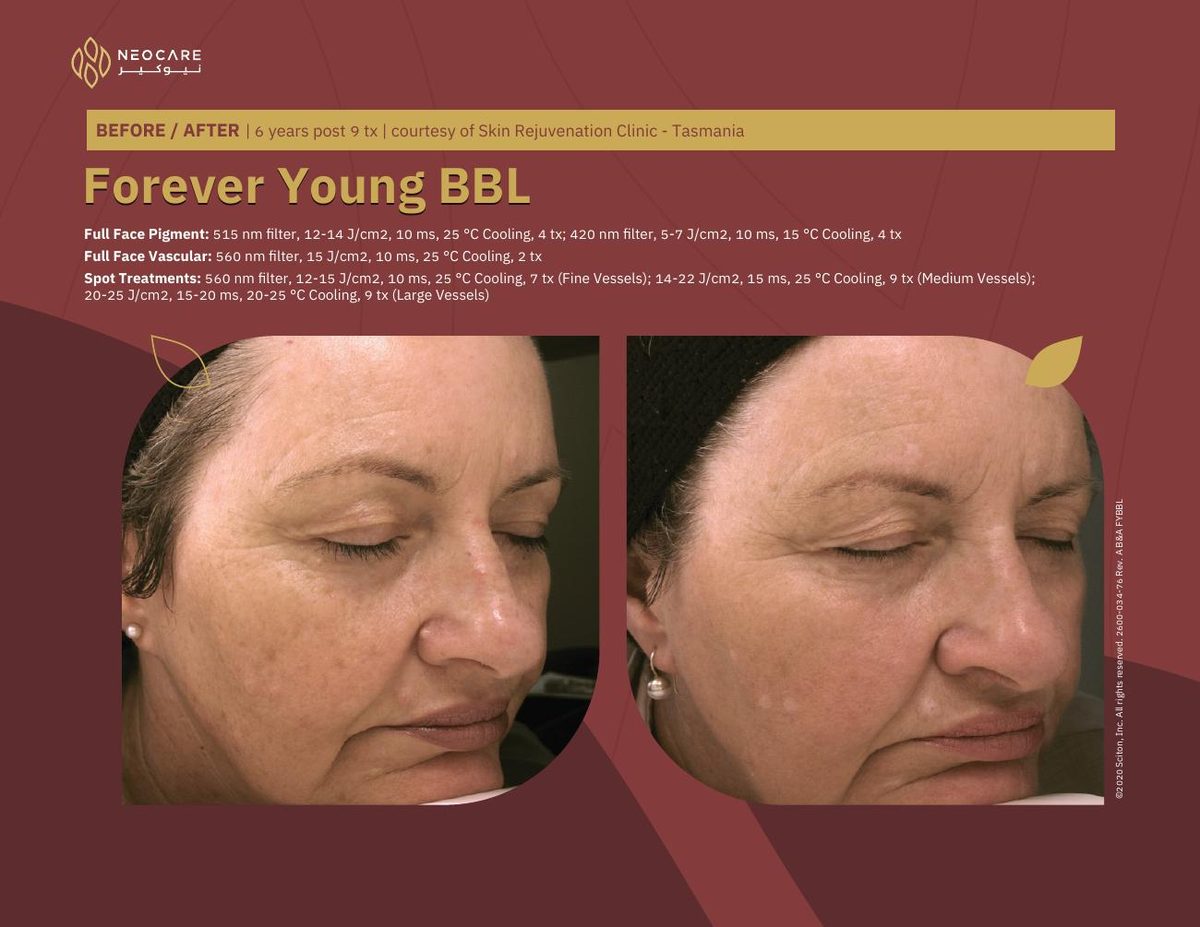 Forever Young BBL before and after 19