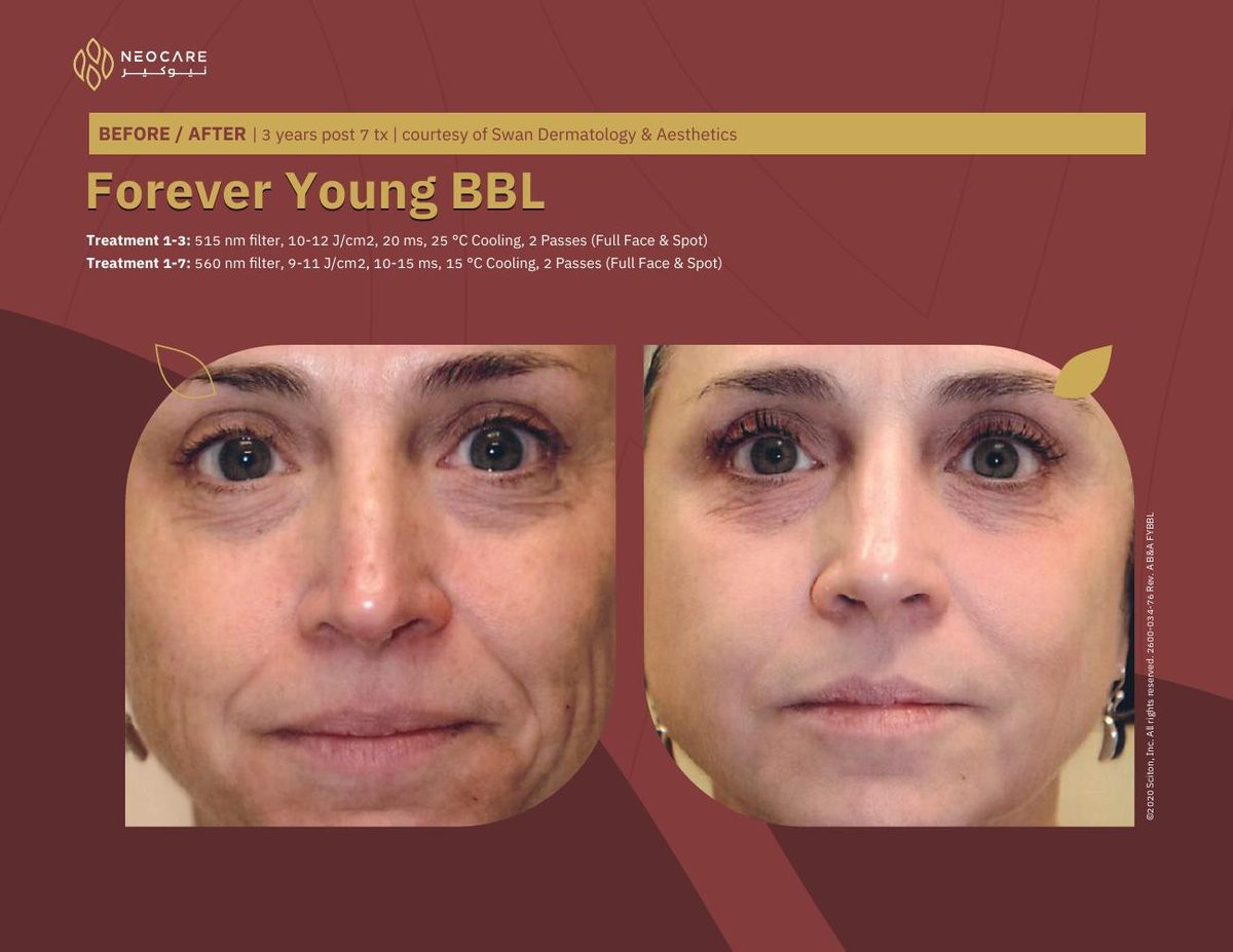Forever Young BBL before and after 20