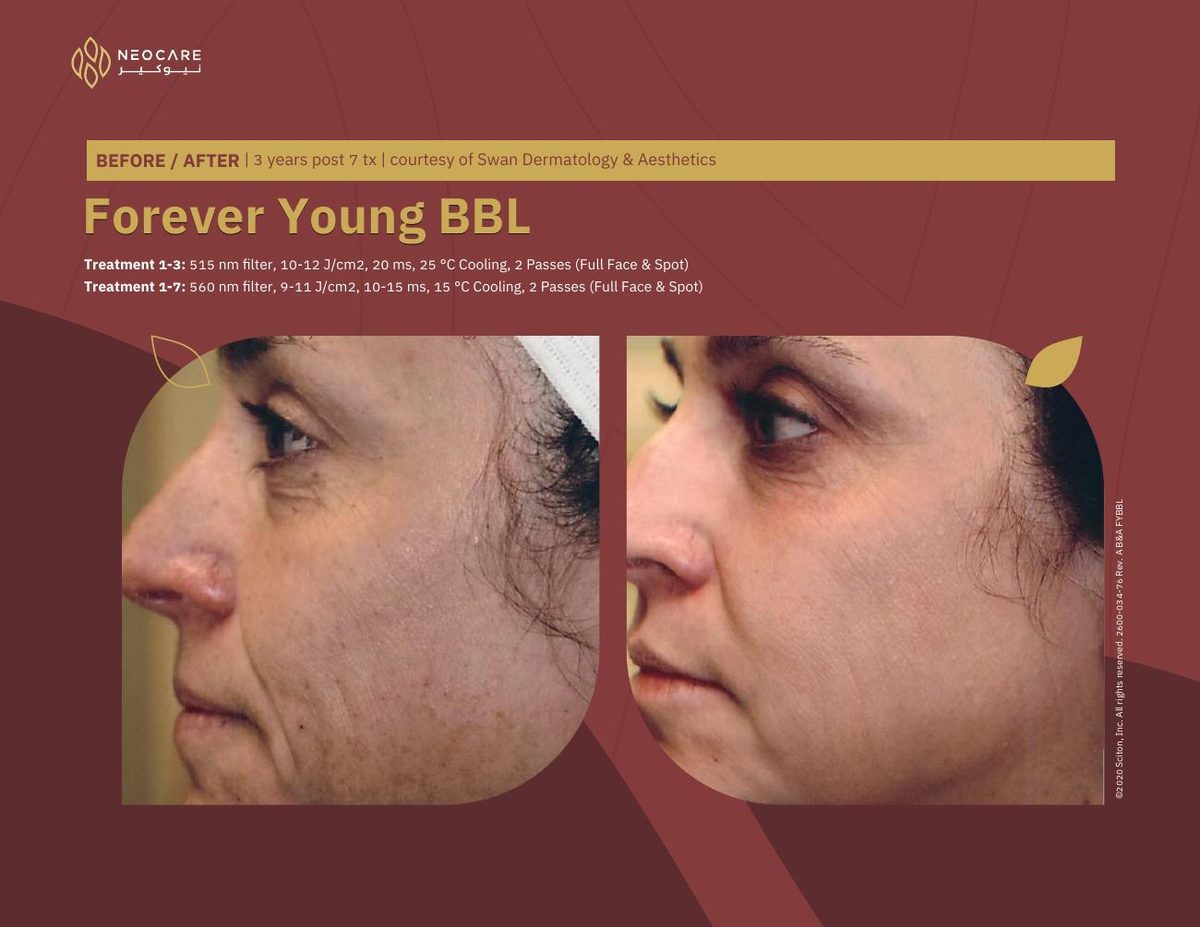 Forever Young BBL before and after 21