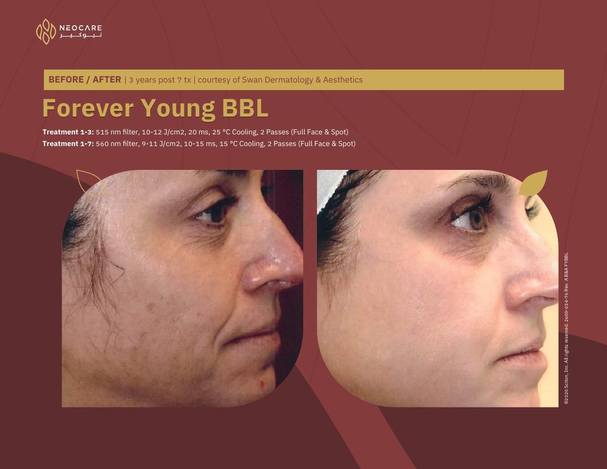 Forever Young BBL before and after 22