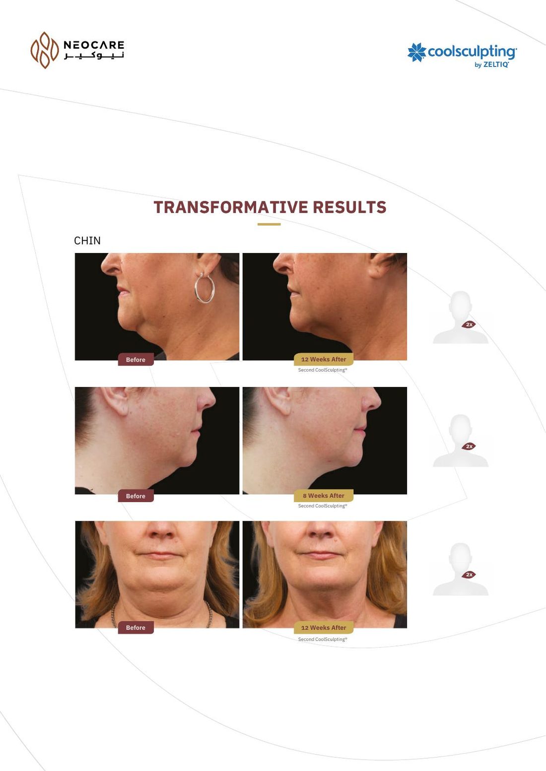 CoolSculpting brochure page 6