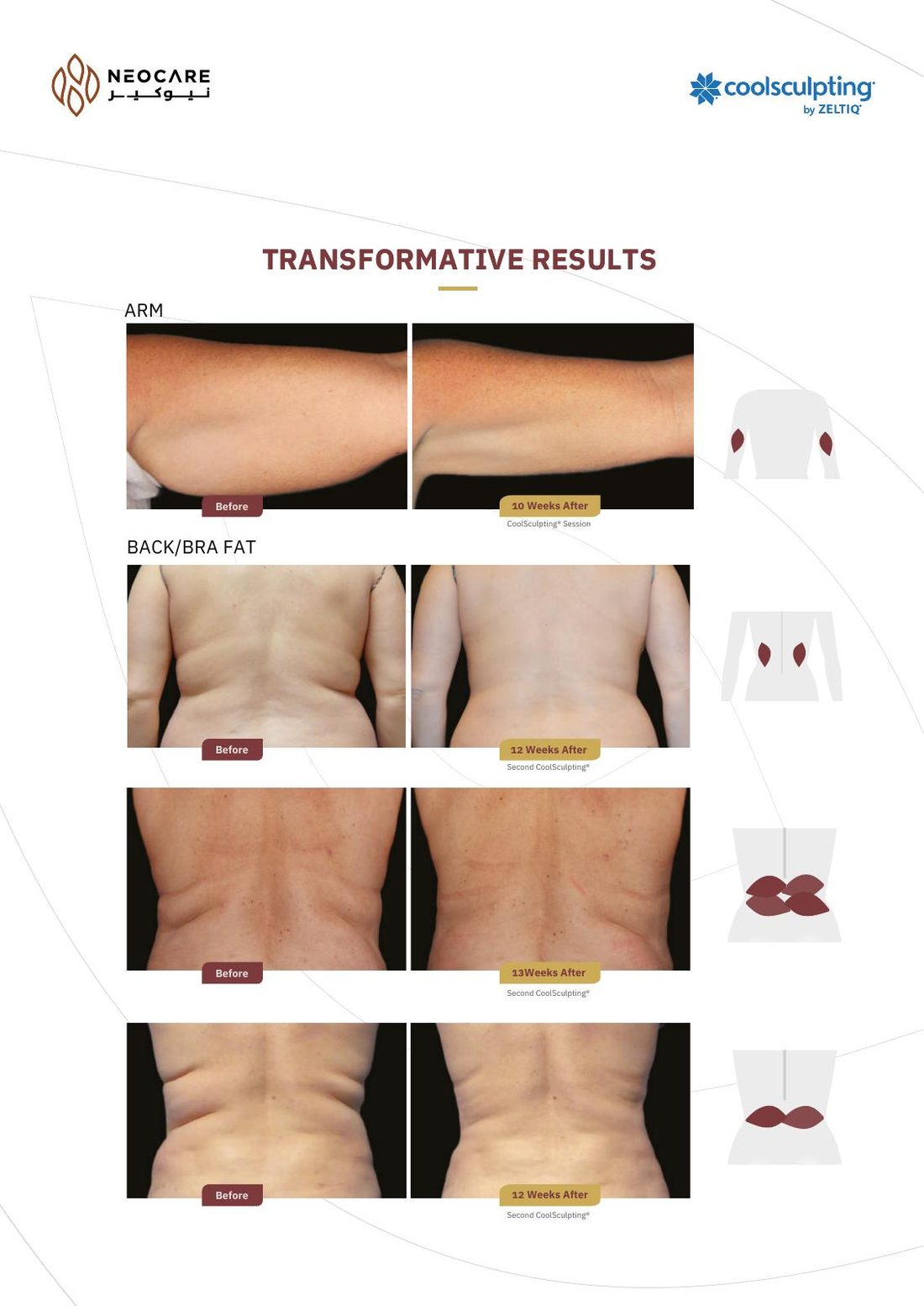 CoolSculpting brochure page 7