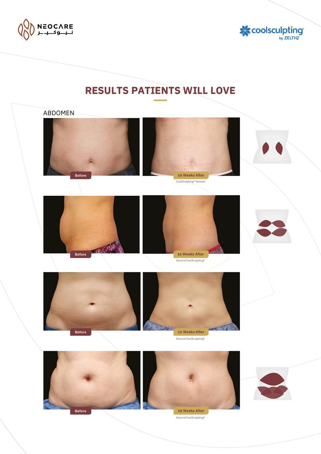 CoolSculpting brochure page 8
