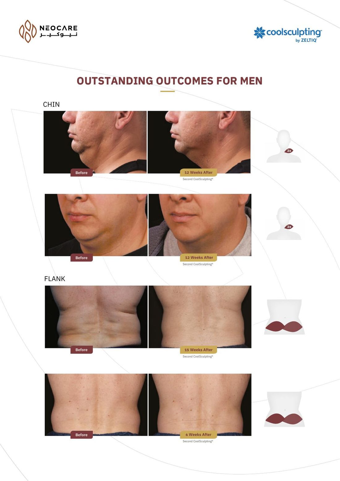 CoolSculpting brochure page 9