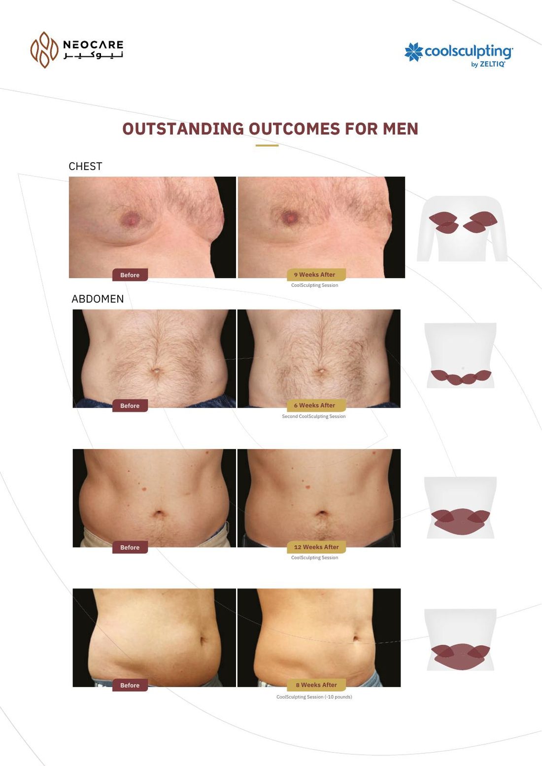 CoolSculpting brochure page 10