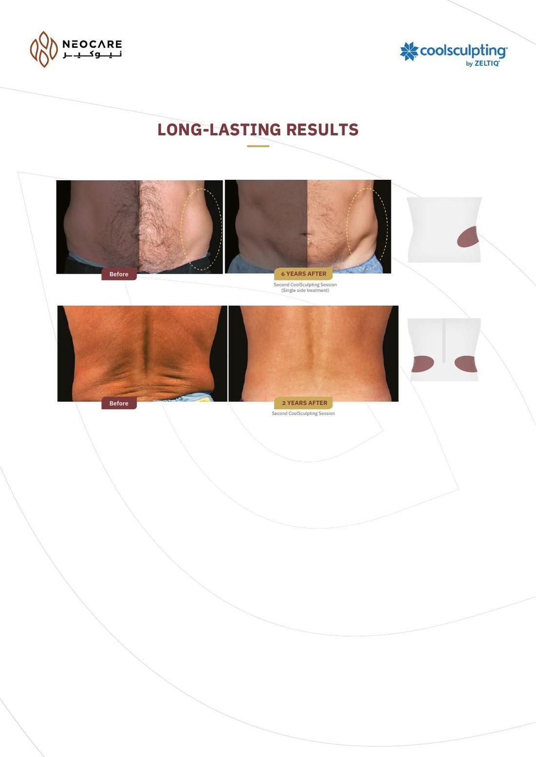 CoolSculpting brochure page 11